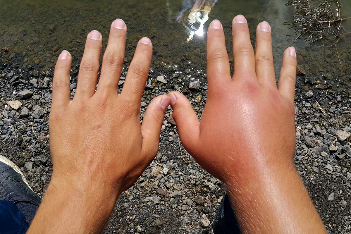 Opuch ruky ako alergická reakcia po uštipnutí či bodnutí