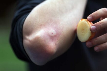 Rozkrojená cibuľa ako prvá pomoc po uštipnutí či bodnutí hmyzom