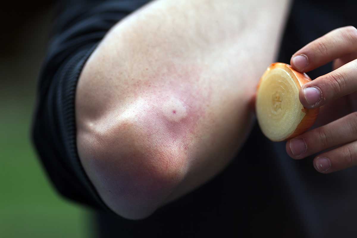 Rozkrojená cibuľa ako prvá pomoc po uštipnutí či bodnutí hmyzom